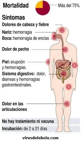 Síntomas del Ébola